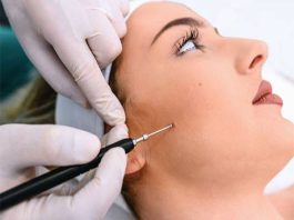 Phá nốt ruồi có phá tướng không và vị trí nào không tẩy