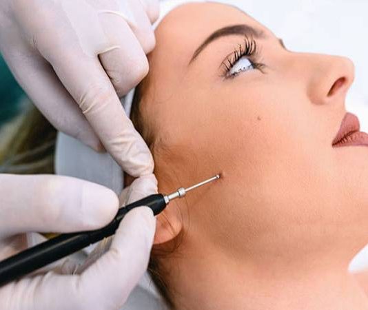 Phá nốt ruồi có phá tướng không và vị trí nào không tẩy