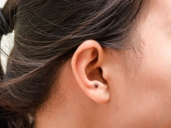 Ý nghĩa nốt ruồi ở tai trái và tải phải