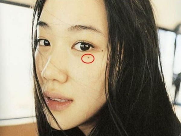 Nốt ruồi lệ là gì nằm ở vị trí nào trên khuôn mặt