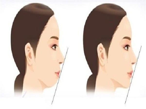 Vận mệnh và hậu vận của người có cằm thụt vào
