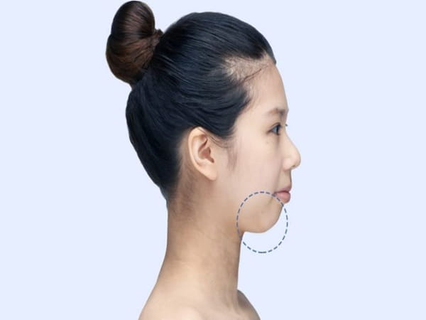 Tướng cằm thụt vào là gì?