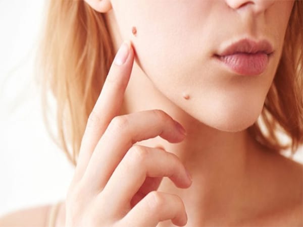 Nốt ruồi bên má và ý nghĩa trong hôn nhân